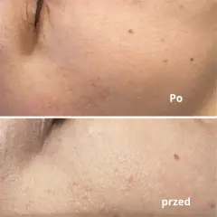 Kiedy makijaż po laserze frakcyjnym? Bezpieczne terminy i zasady