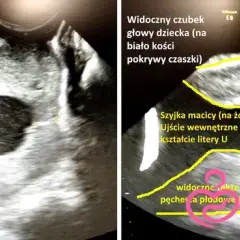 Skrócona szyjka macicy a poród: Kiedy spodziewać się rozwiązania?