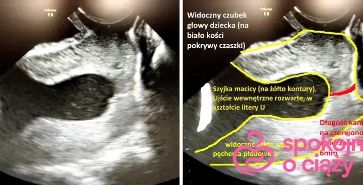 Skrócona szyjka macicy a poród: Kiedy spodziewać się rozwiązania?