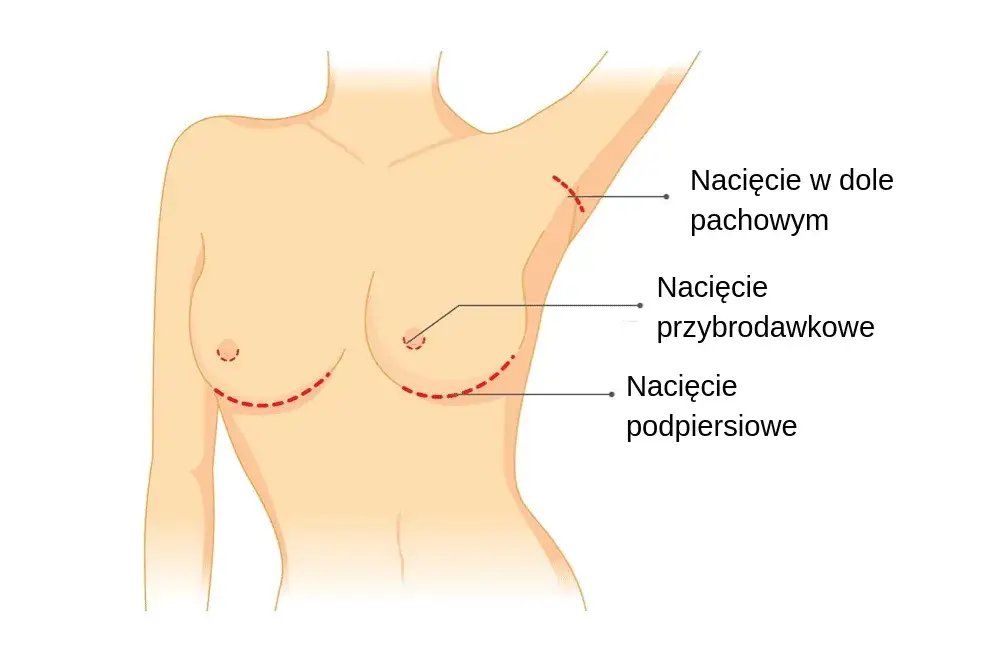 Zdjęcie Ile kosztuje powiększenie biustu w Niemczech? Ceny i porady